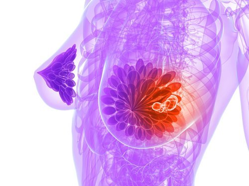 O que é carcinoma coloide de mama?