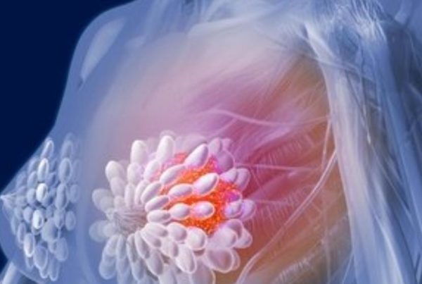 carcinoma ductal in situ