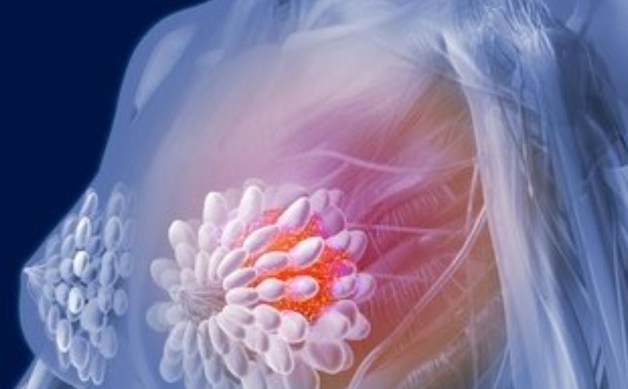 carcinoma ductal in situ