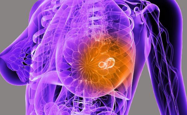 carcinoma tubular invasivo