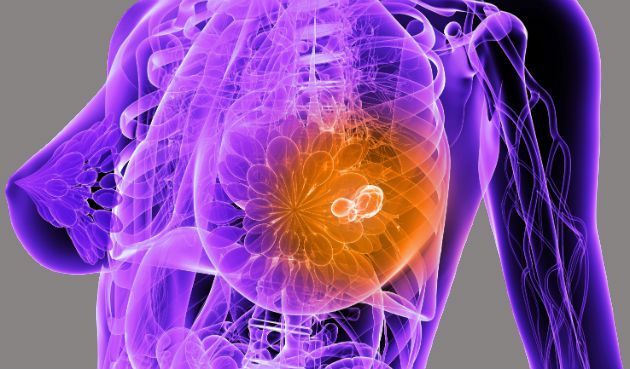 cancer mamar malign invaziv pastile împotriva viermilor roților