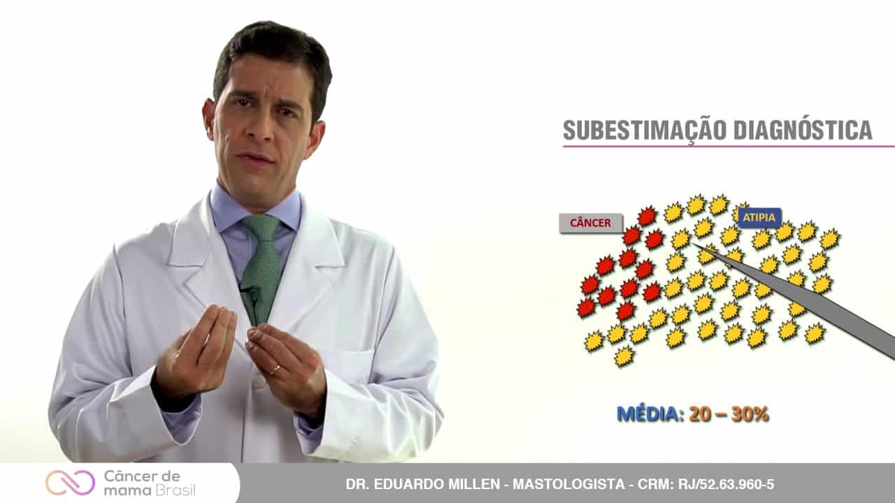 Quando a cirurgia é necessária após a biópsia da mama?