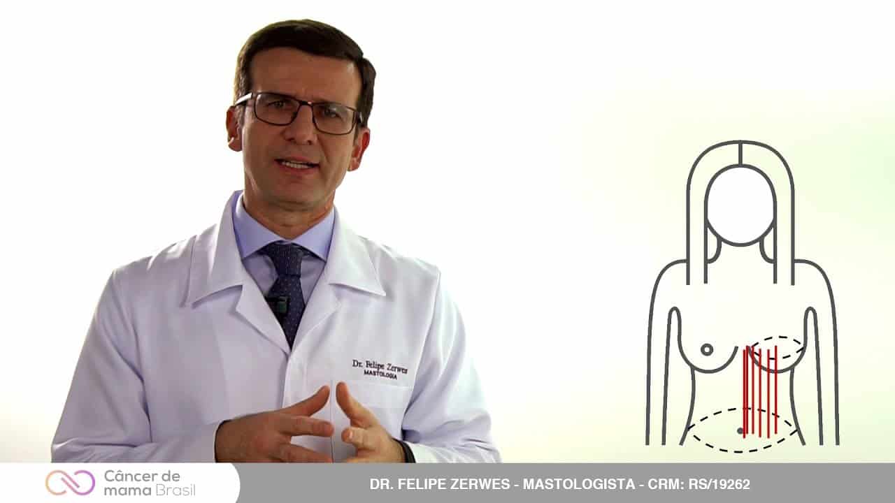 Reconstrução mamária com retalhos miocutâneos – Tram e grande dorsal