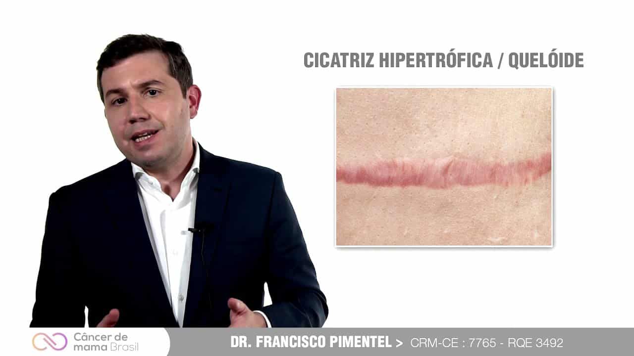 Complicações da cirurgia do câncer de mama