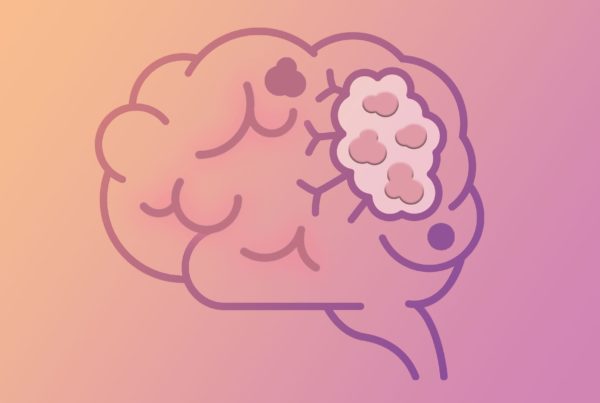 Tratamento de metástase cerebral do câncer de mama