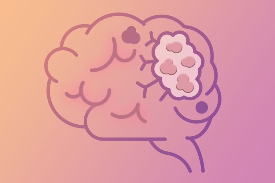 Tratamento de metástase cerebral do câncer de mama