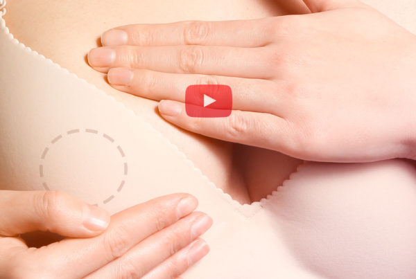 MASTECTOMIA POUPADORA DO COMPLEXO ARÉOLO PAPILAR NIPLLE SPARING MASTECTOMY