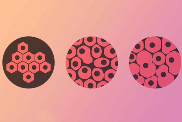 O que é grau nuclear e grau histológico?