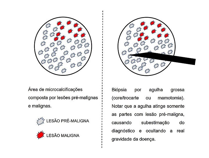 Risco da biópsia inicial subestimar doença de maior risco