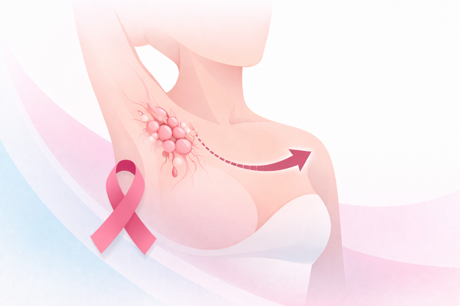 Redução da Cirurgia Axilar em Câncer de Mama — Novas Evidências Apresentadas no San Antonio 2025